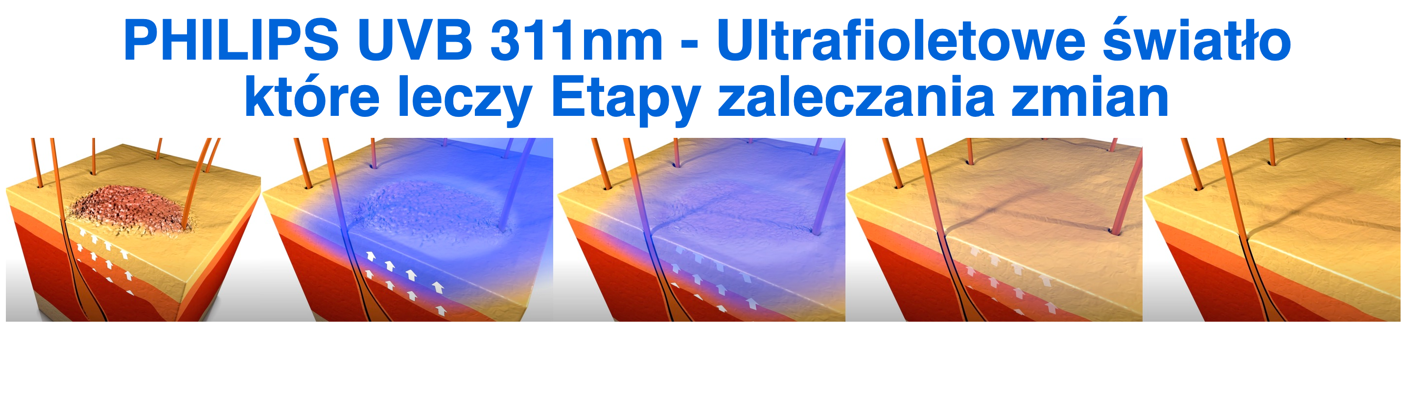 philips uvb 311