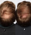 theradome-lh40-evo-laser-helmet-hair-growth-specialist-2_299x333_crop_center@2x.jpg