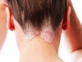 psoriasis-4-iStock_00001210.jpg