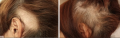 łysienie.png