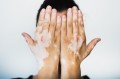 8-Vitiligo.jpg